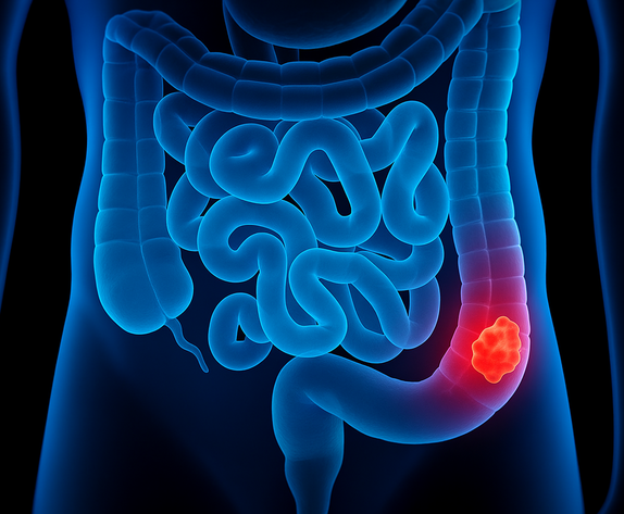 CX-5461/Cemiplimab- in  Refractory Microsatellite Stable Colorectal Cancer