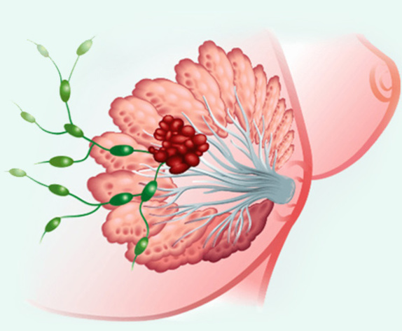 CX-5461-HER2 Positive Solid Tumors and Breast Cancer